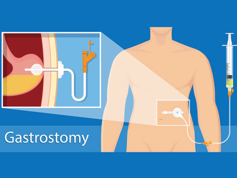 gastrostomy
